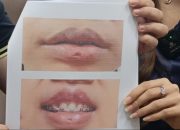 Korban Eks Finalis Putri Indonesia Riau Ceritakan Kegagalan Operasi Bibir Berujung Cacat