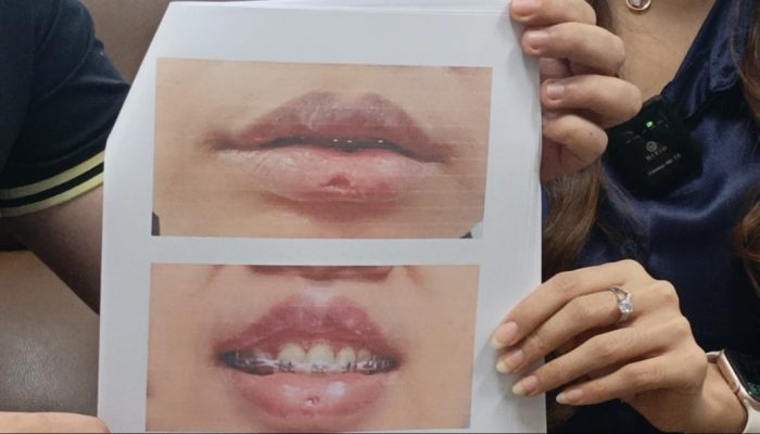 Korban Eks Finalis Putri Indonesia Riau Ceritakan Kegagalan Operasi Bibir Berujung Cacat